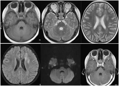 Case report: A toxoplasmic encephalitis in an immunocompromised child detected through metagenomic next-generation sequencing